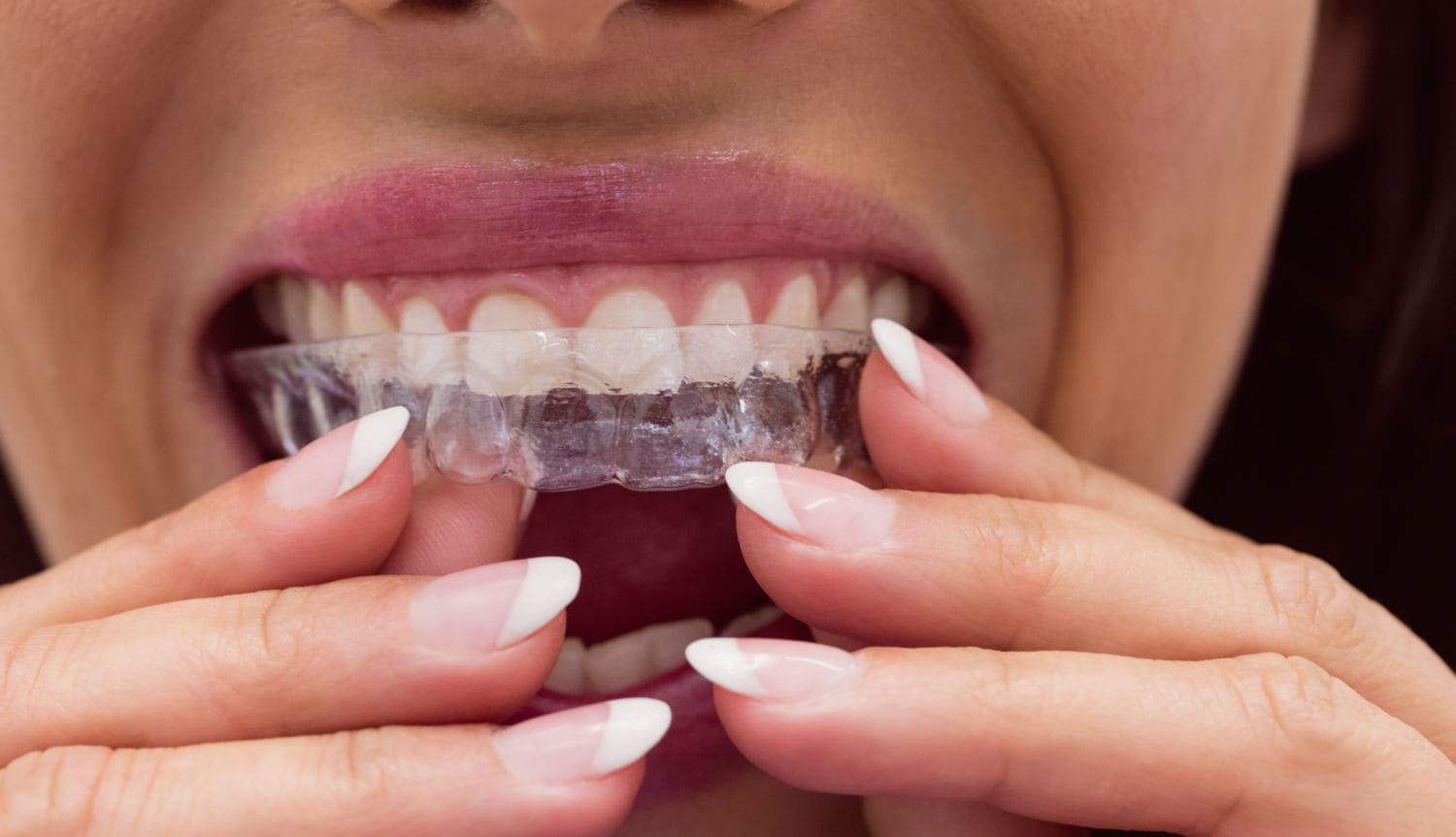 Clear aligner orthodontic treatment at Yūgen Dental in Sandton